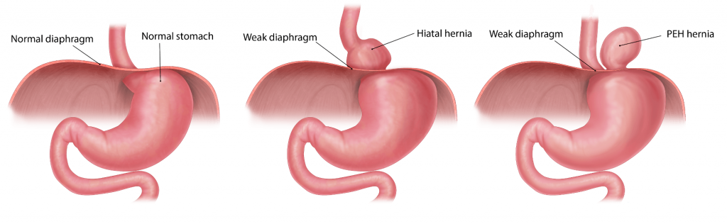 Paraesophageal Hernia GBMC Jordan