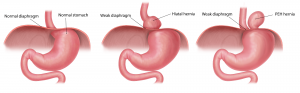 Paraesophageal Hernia – GBMC Jordan