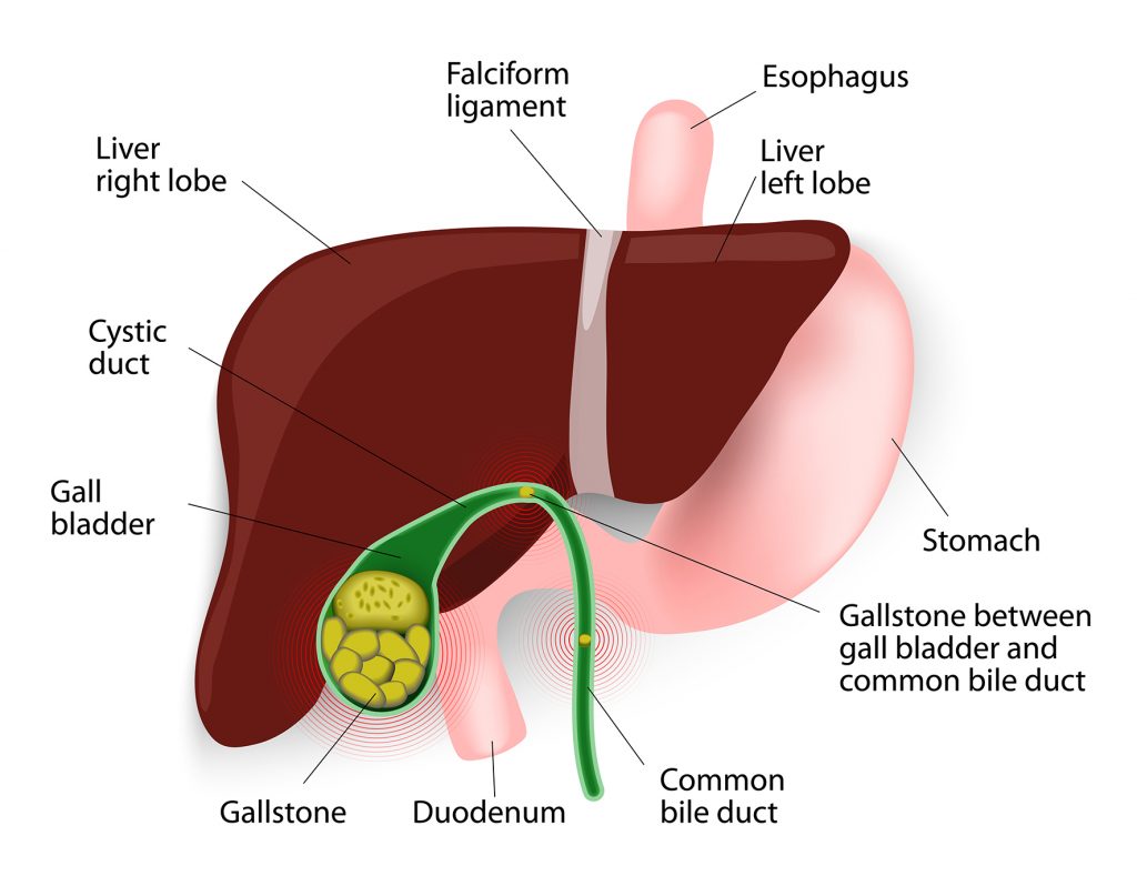 Stones In Gallbladder And Common Bile Duct Gbmc Jordan