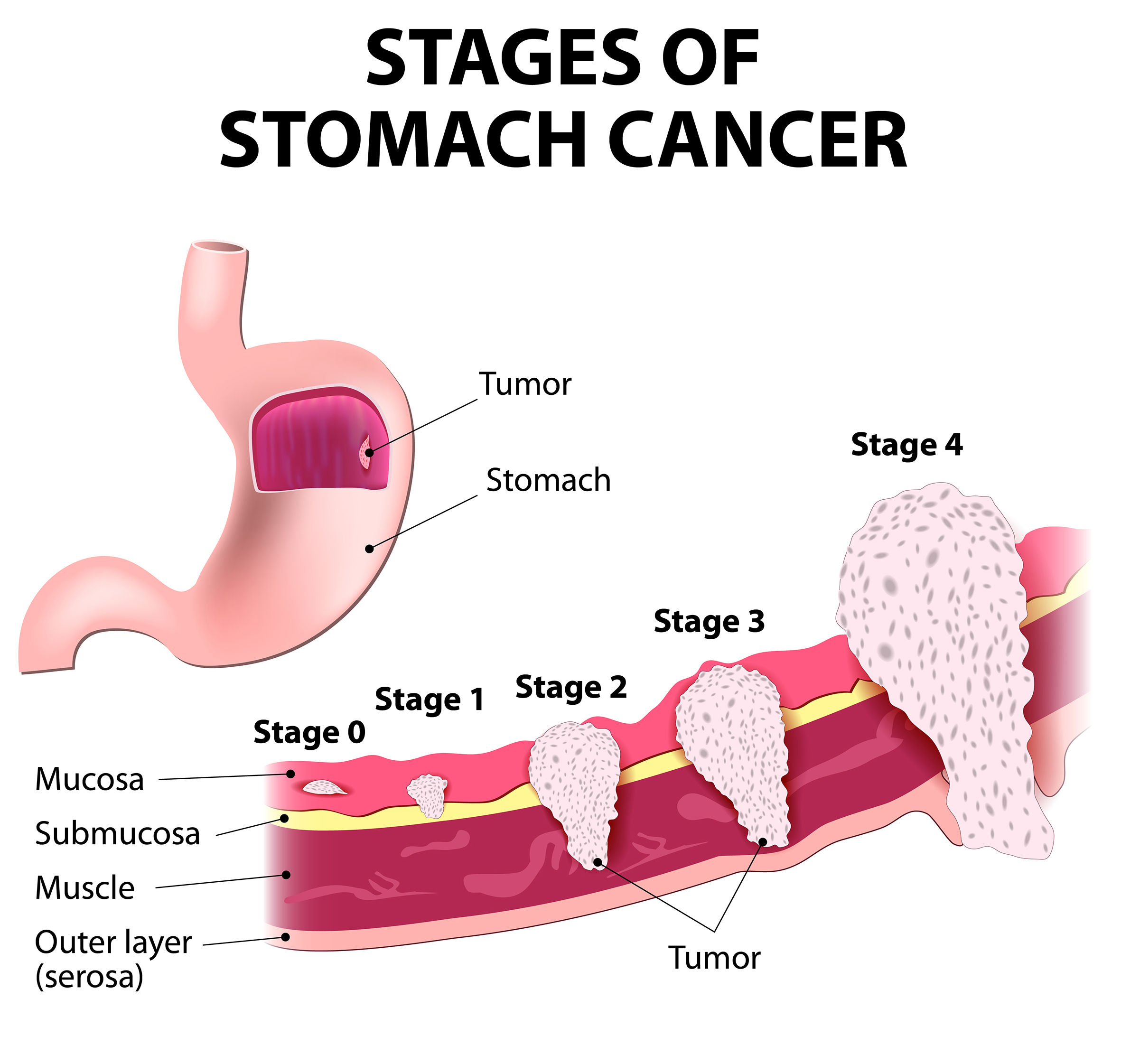 Tumors GBMC Jordan