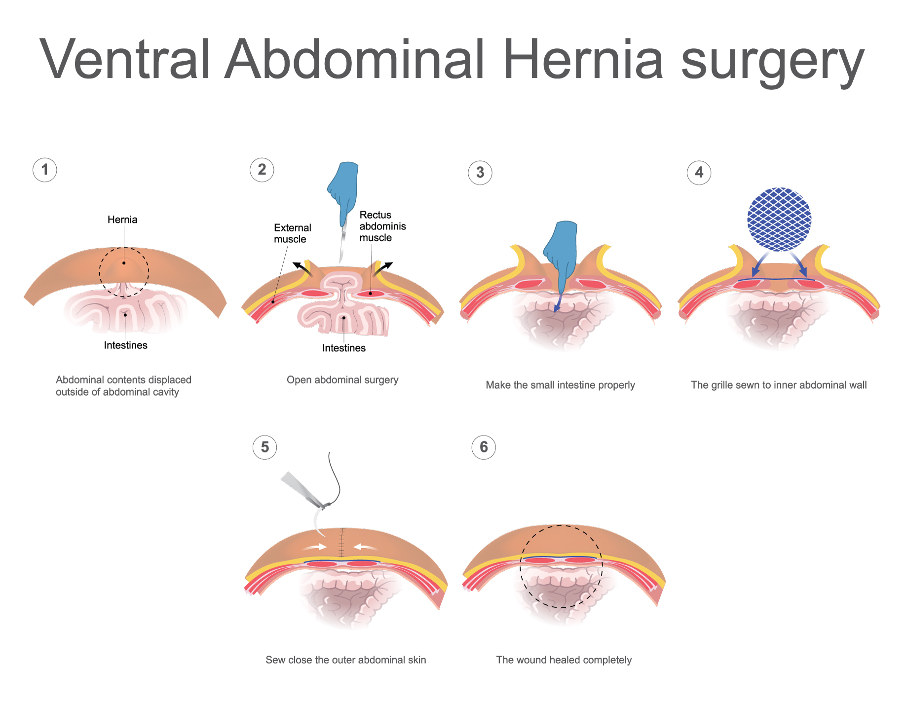 Ventral Hernia Repair GBMC Jordan