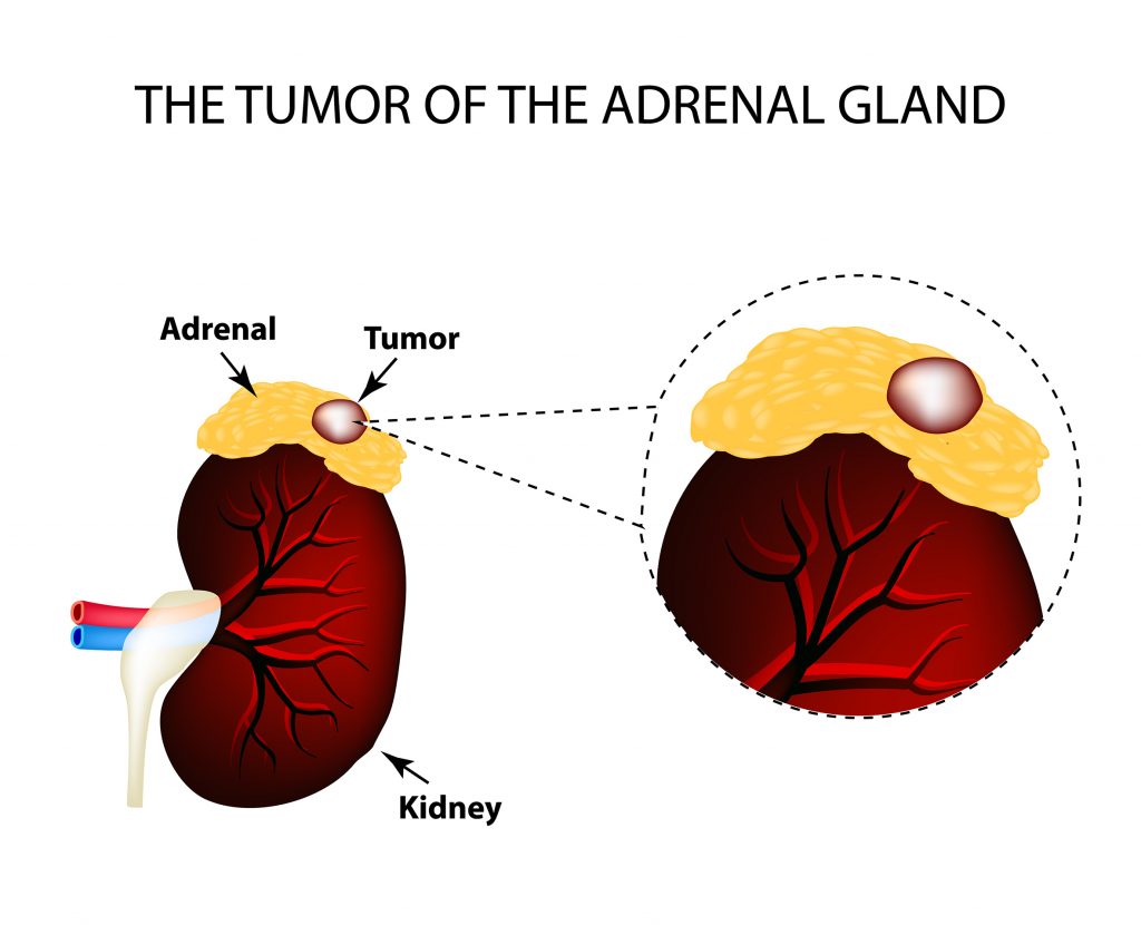 Adrenal Gland Tumor Removal Surgery at Dayna Allen blog