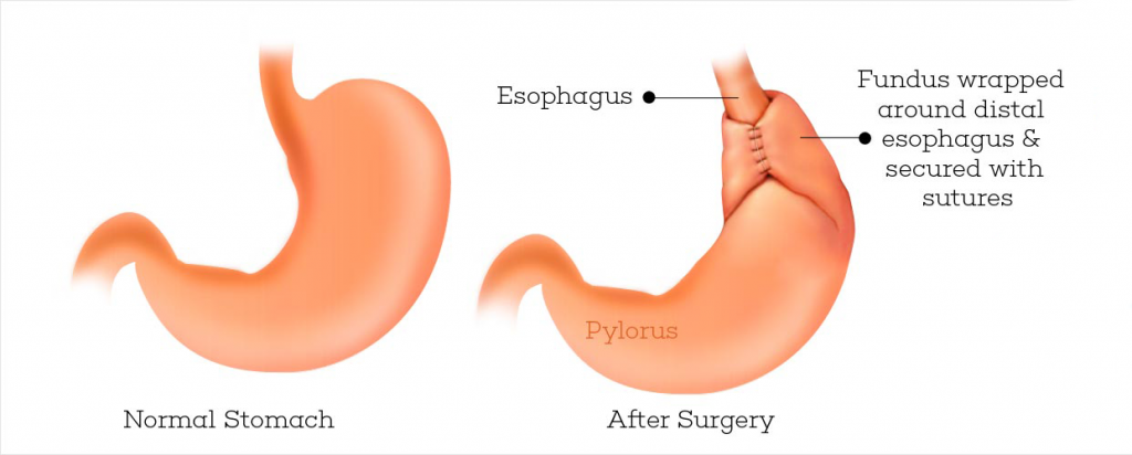 Nissen Fundoplication – GBMC Jordan