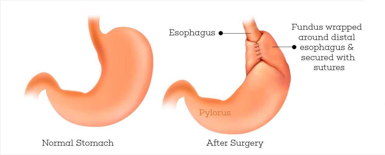 Nissen Fundoplication GBMC Jordan