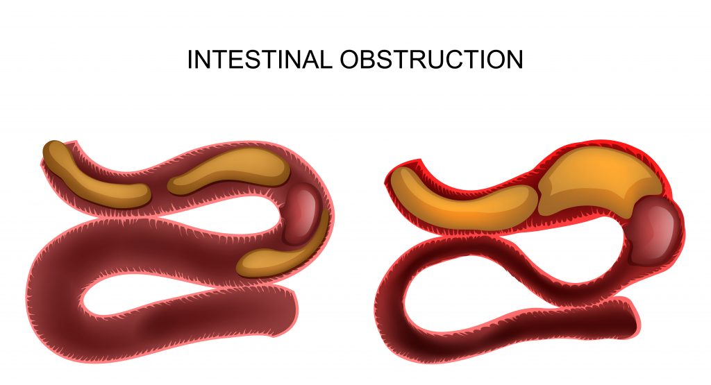 Bowel Obstruction Overview Of Causes Clinical Feature - vrogue.co